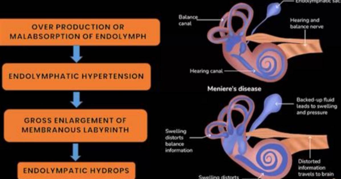 Why Do Endolymphatic Hydrops Occurs?