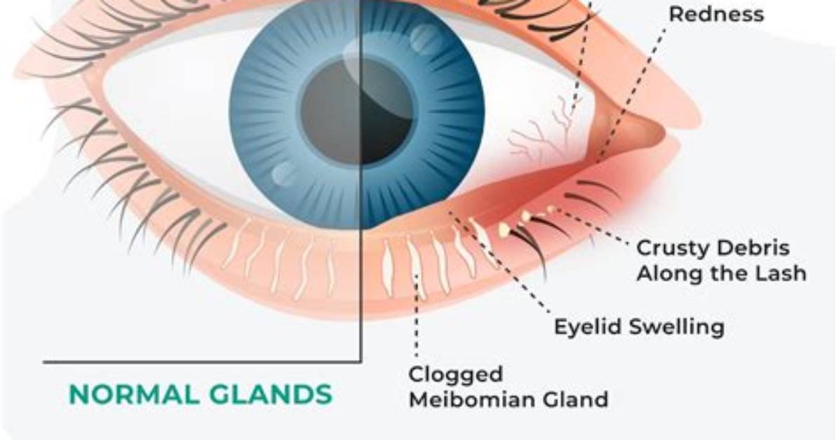 Why Do Eye Glands Get Blocked?