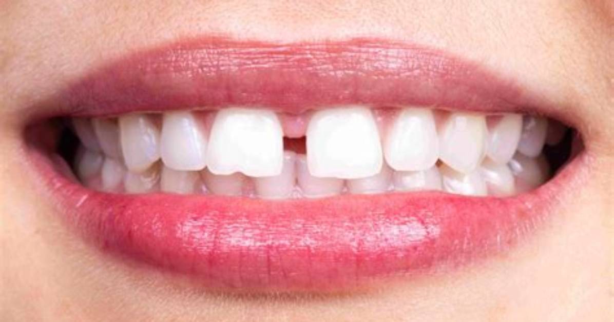 Why Do Front Teeth Have Gaps?