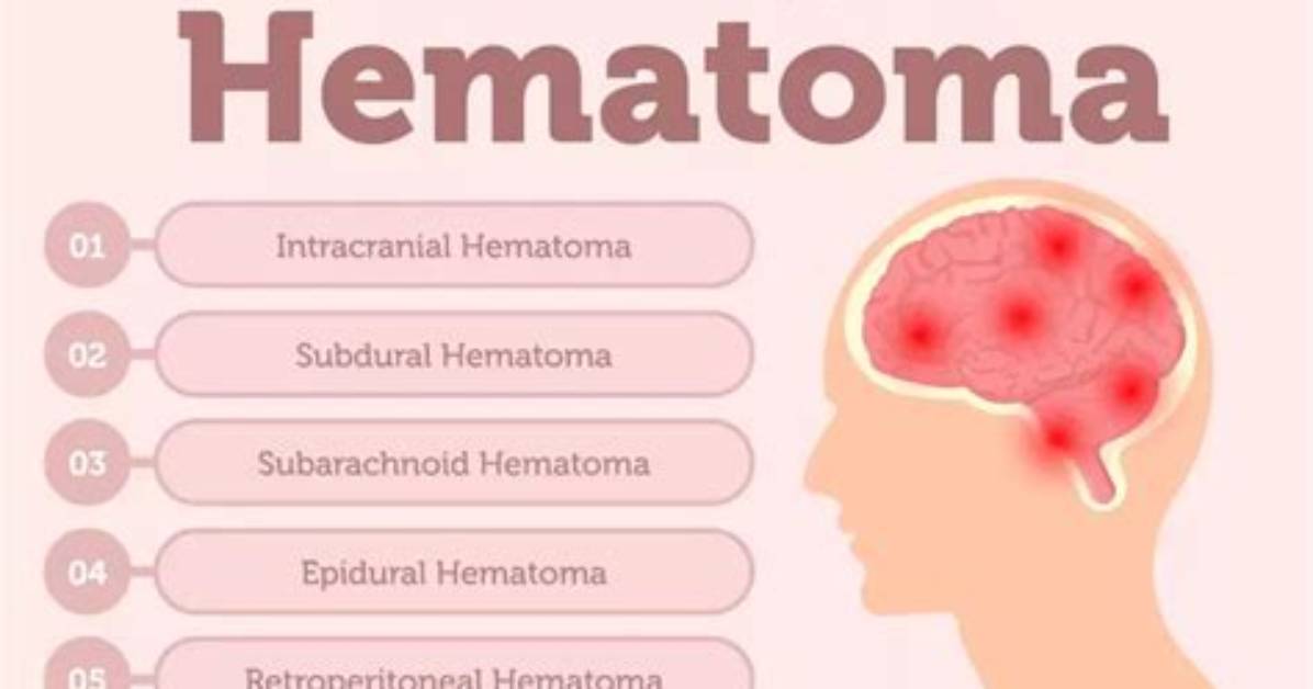 Why Do Haematomas Occur?