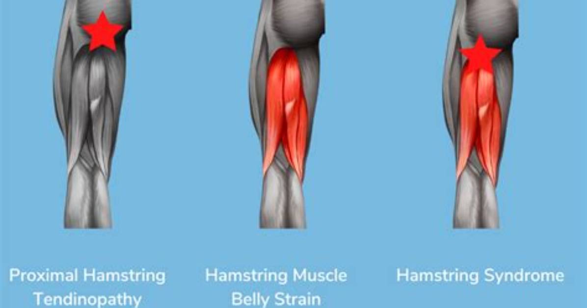 Why Do Hamstrings Crack?