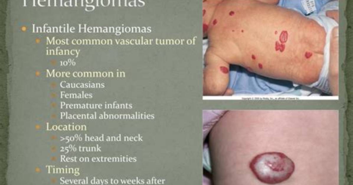 Why Do Hemangiomas Ulcerate?