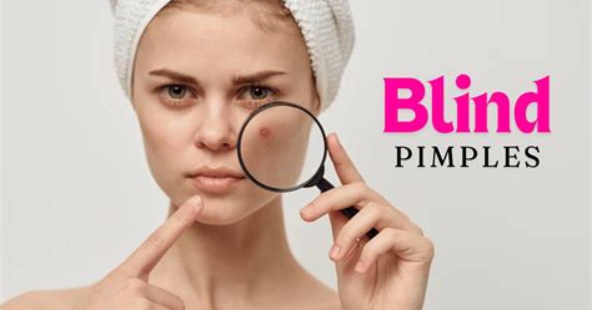 Why Do I Get Blind Pimples in the Same Spot?