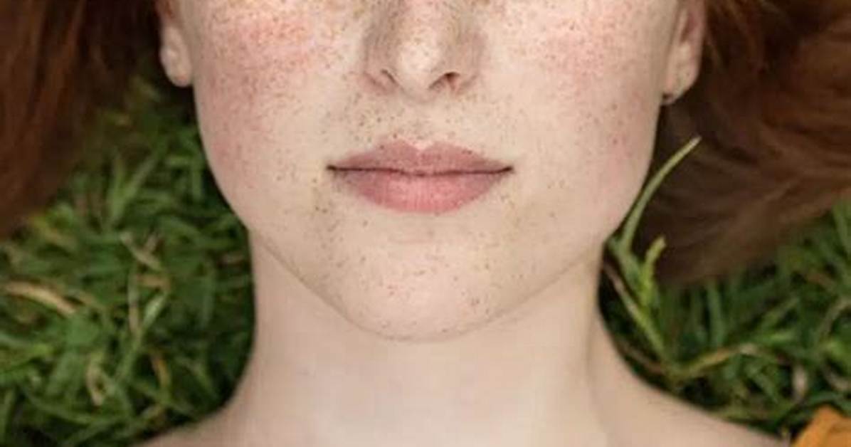 Why Do I Get Freckles Even with Sunscreen?