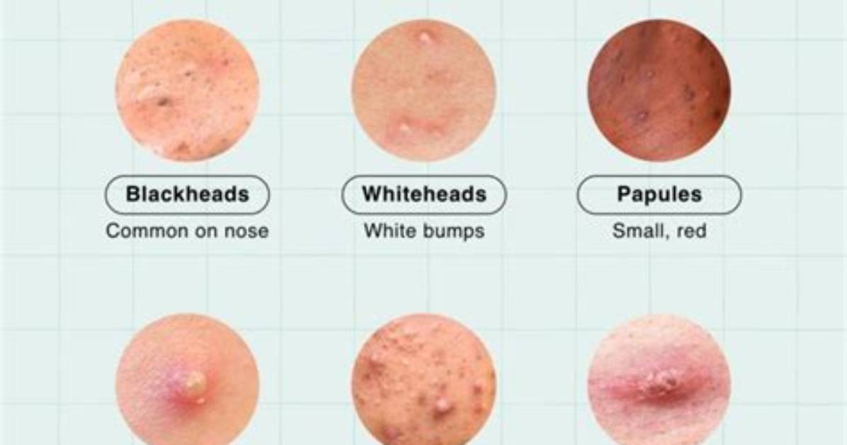 Why Do I Get Pimples Between My Eyebrows?