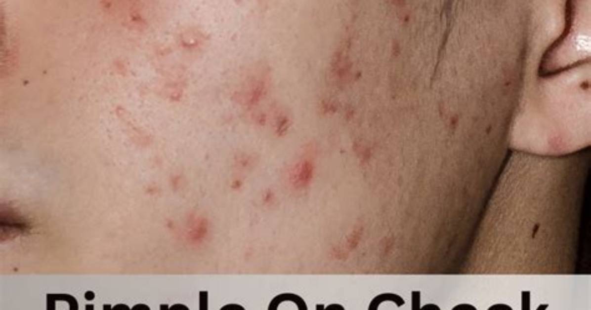 Why Do I Get Pimples on Back of Neck?