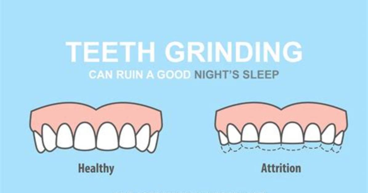 Why Do I Grind My Teeth a Lot?