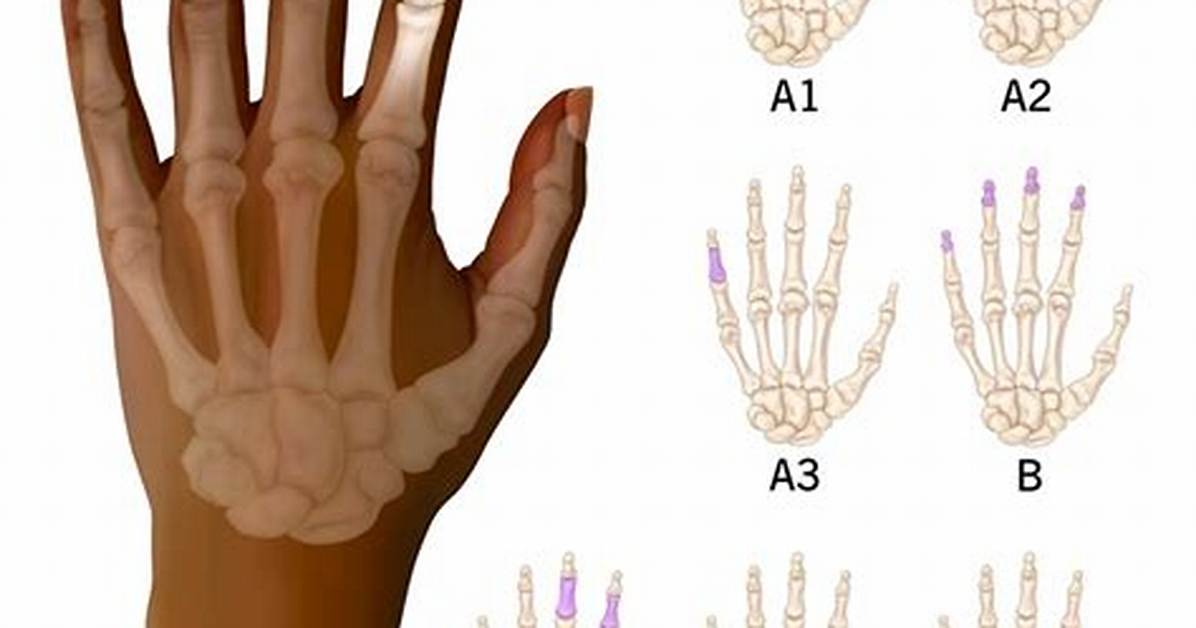 Why Do I Have Brachydactyly Type D?