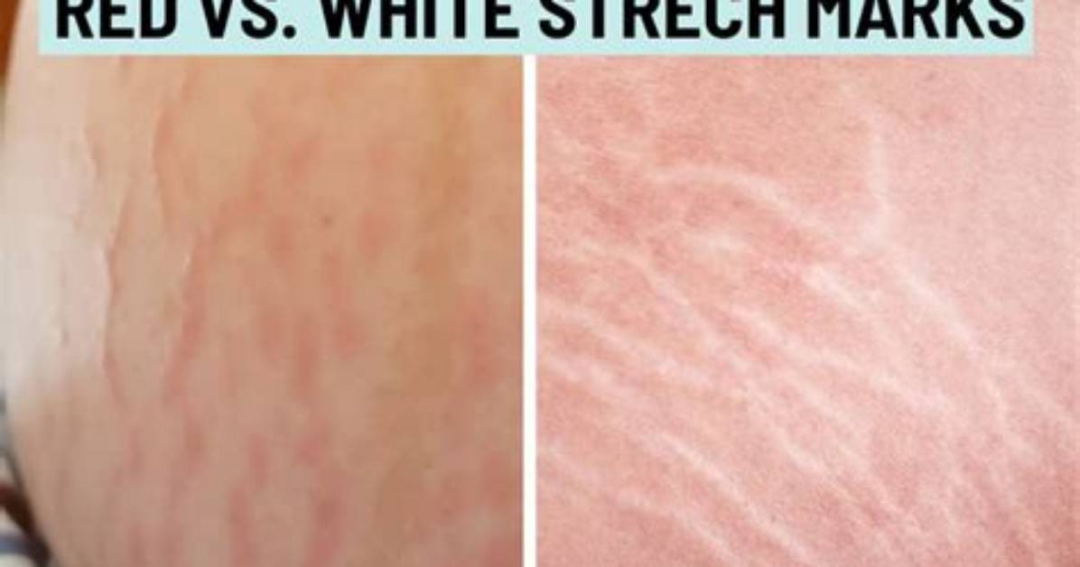 Why Do I Have Red Stretch Marks on My Breasts?