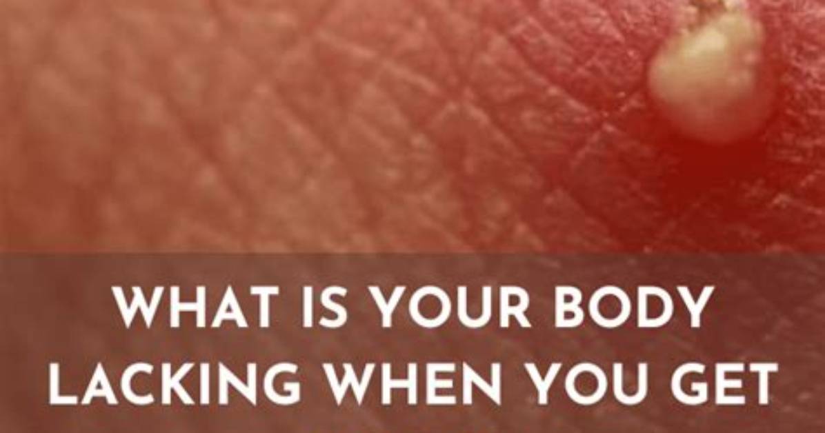 Why Do I Keep Getting Boils on My Bum?