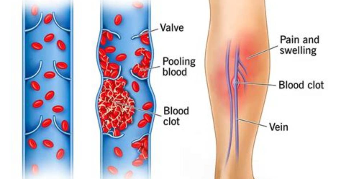Why Do I Keep Getting Superficial Thrombophlebitis?
