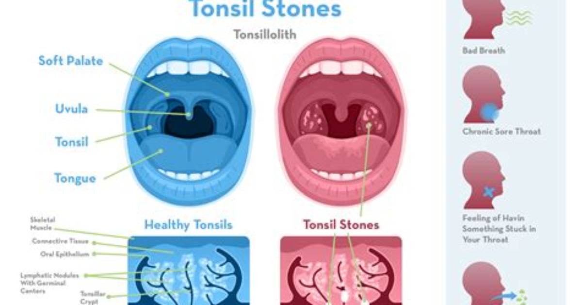 Why Do I Keep Getting Tonsil Stones?