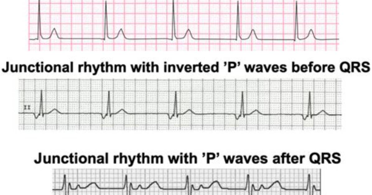 Why Do Junctional Rhythms Occur?