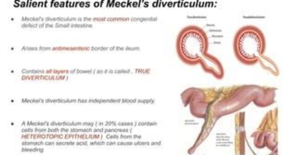 Why Do Meckel's Diverticulum Bleed?