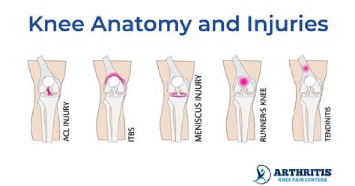 Why Do My Knees Hurt?
