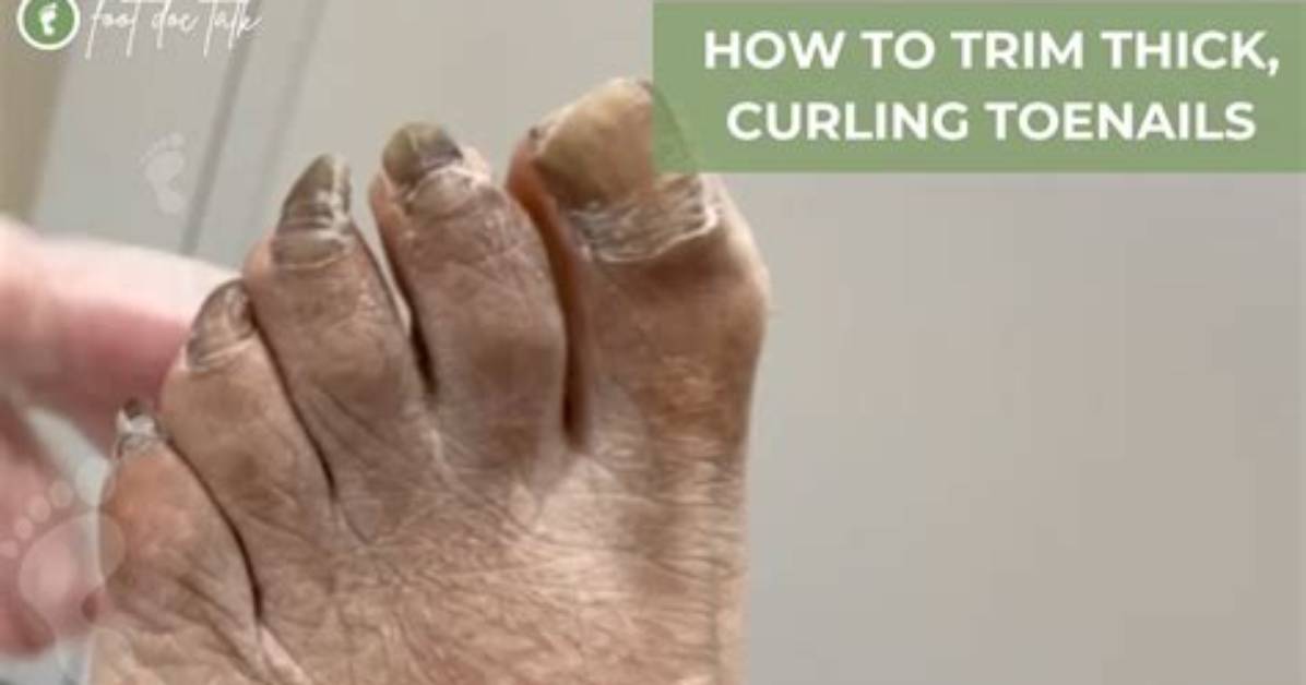Why Do My Toenails Curl Down?