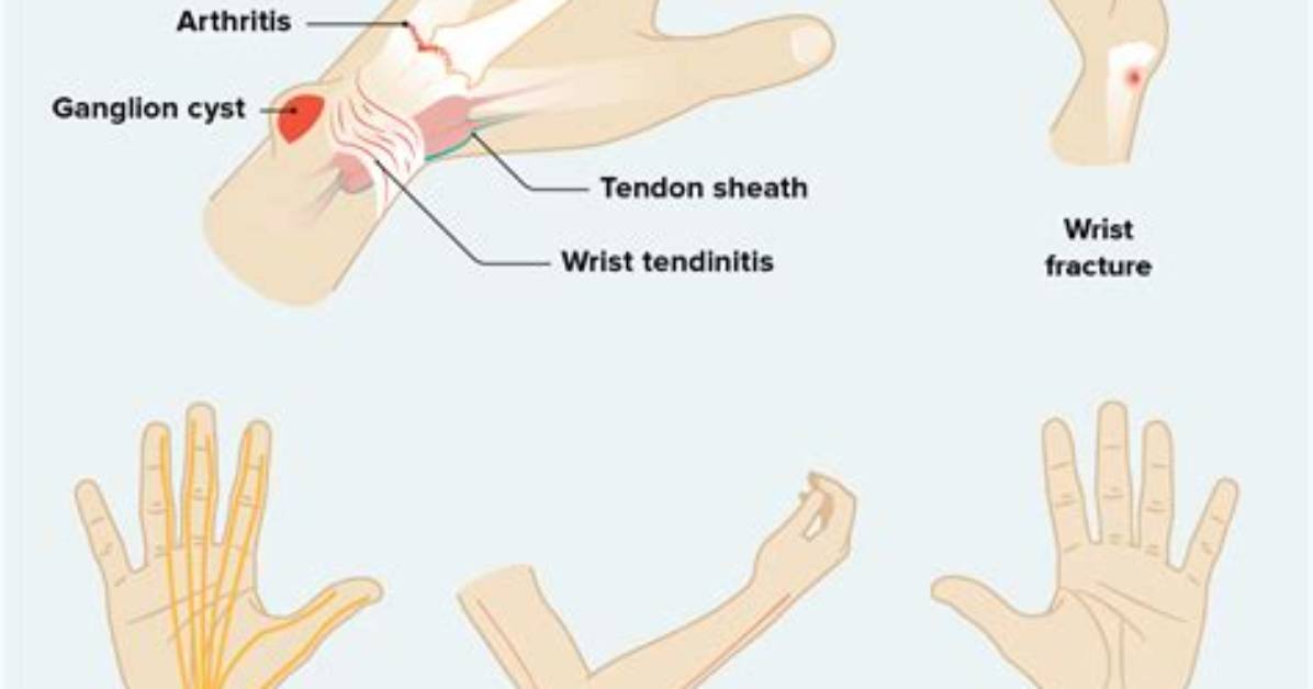 Why Do My Wrists Hurt?