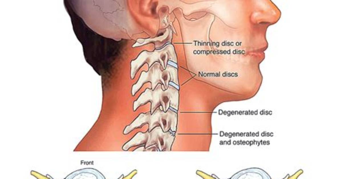 Why Do Neck Cricks Happen?