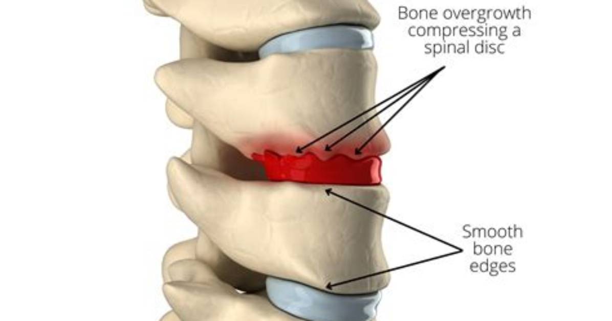 Why Do Osteophytes Develop?