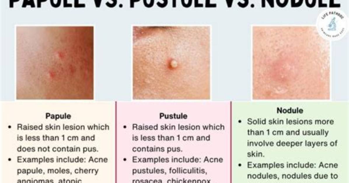 Why Do Papules Form?