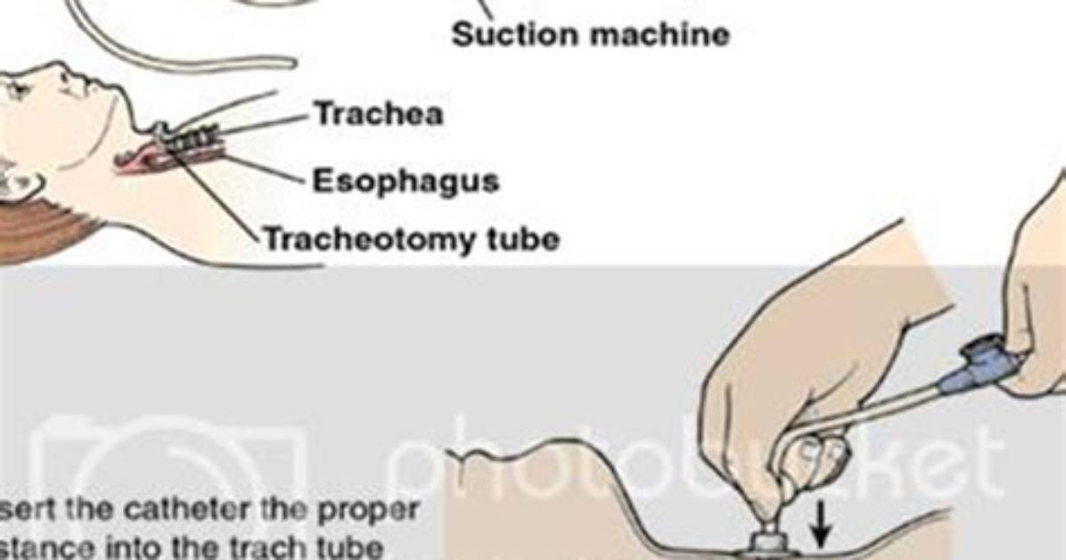 Why Do Patients Need Suctioning