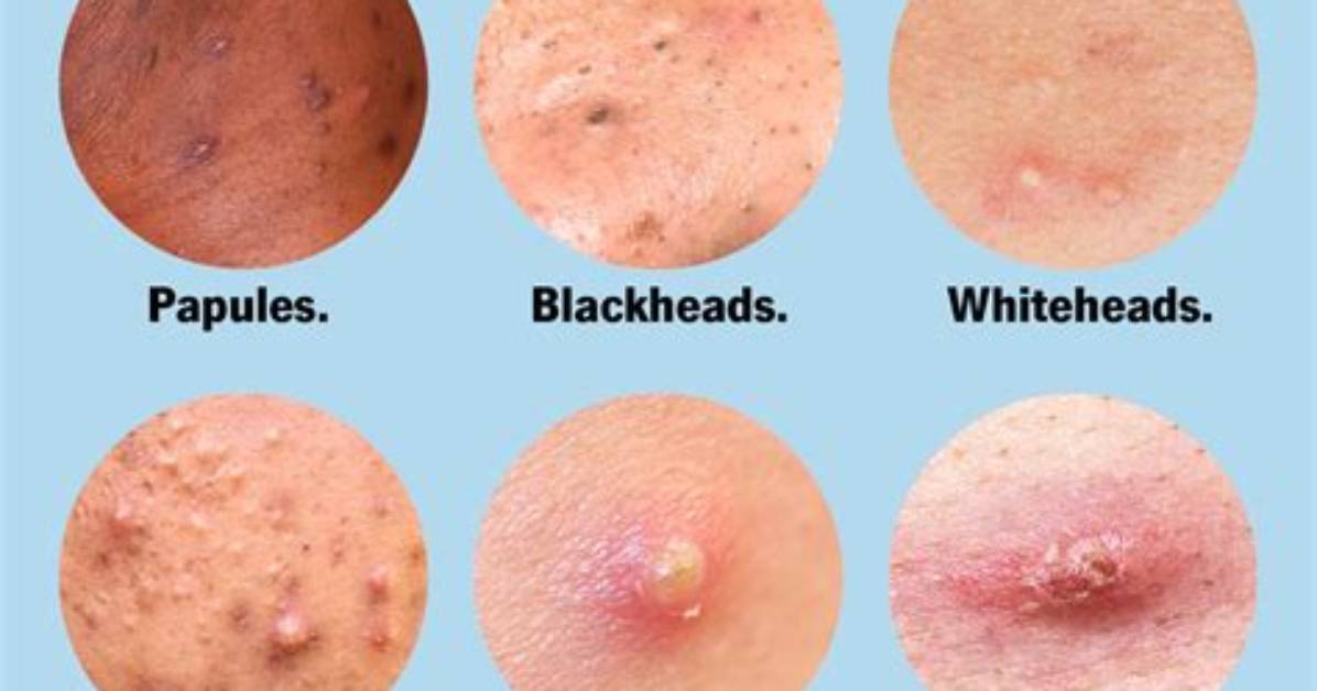 Why Do Pimples Explode When Popped?