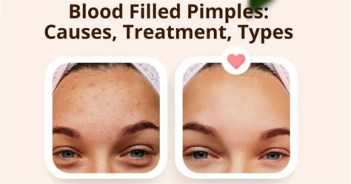 Why Do Popped Pimples Bleed?