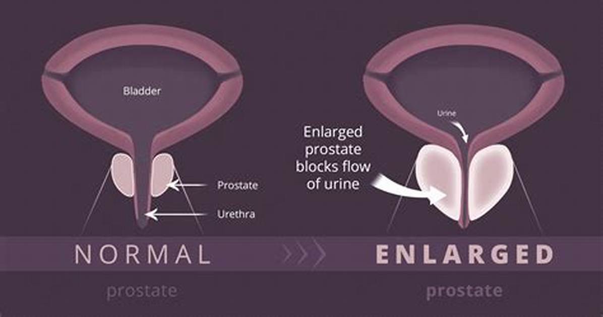 Why Do Prostates Enlarge with Age?