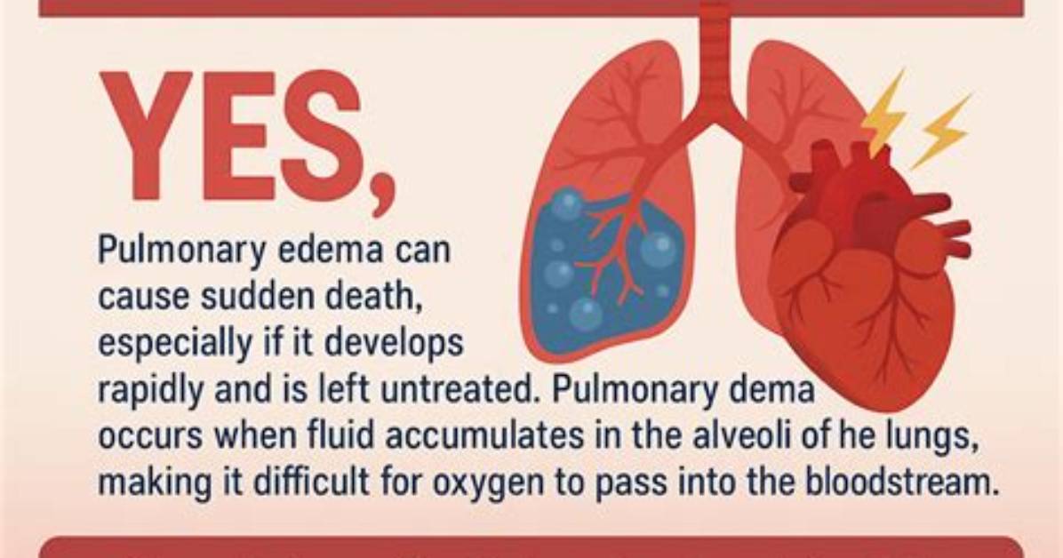 Why Do Tocolytics Cause Pulmonary Edema?