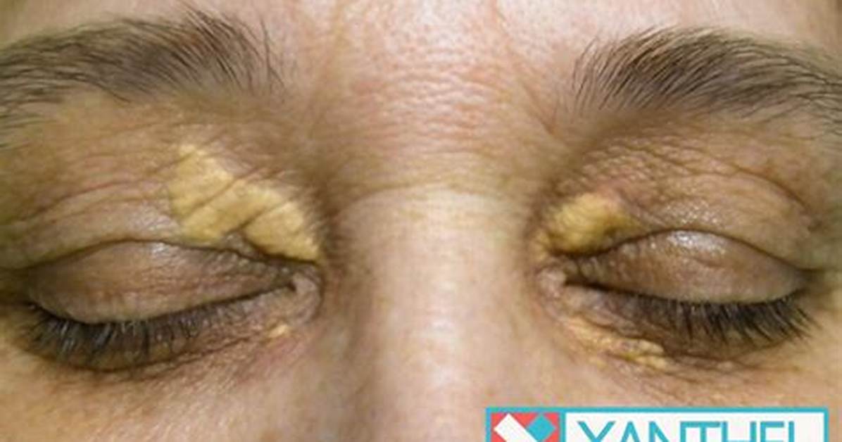 Why Do You Get Xanthelasma?