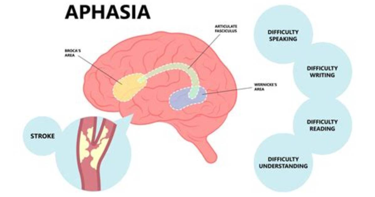 Why Does Aphasia Occur?