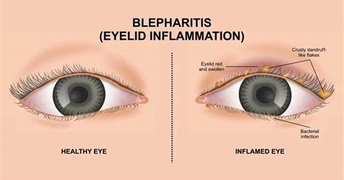 Why Does Blepharitis Flare up?