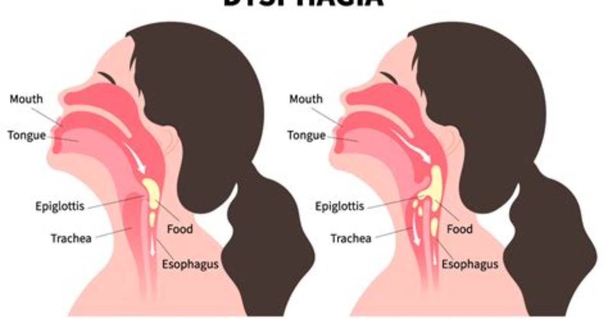 Why Does Dysphagia Happen