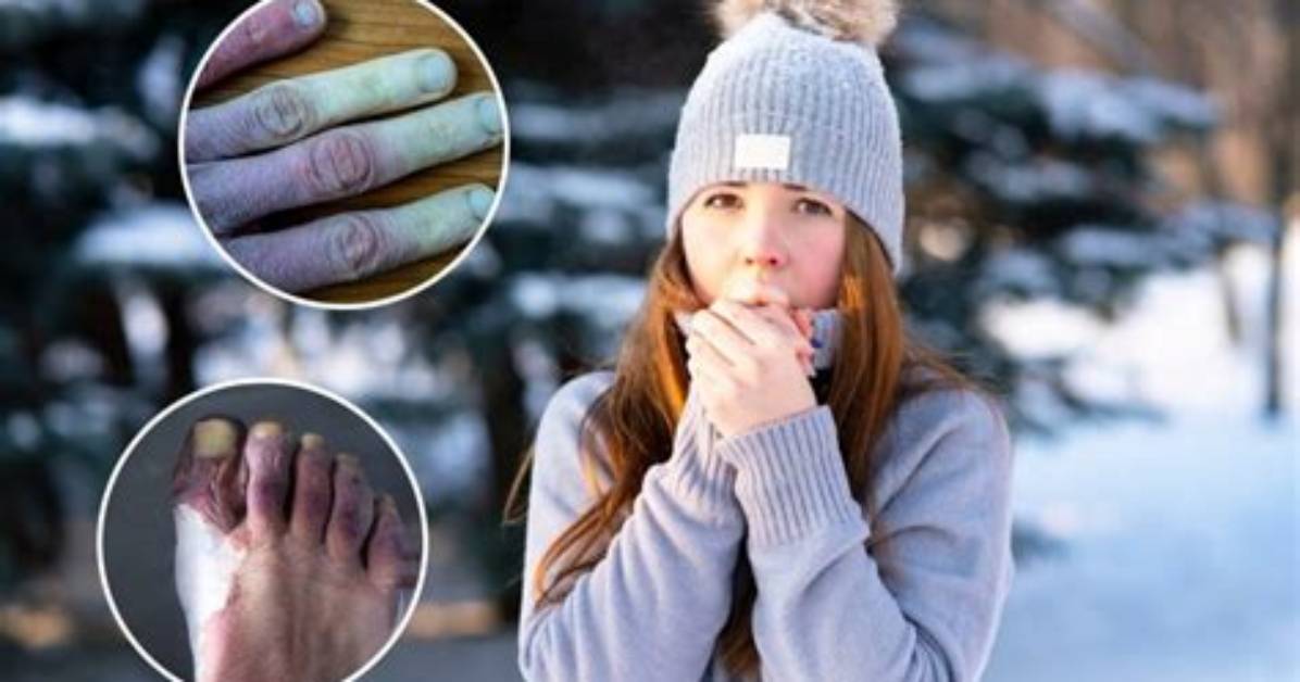 Why Does Frostbite Occur in Mountain Climber?