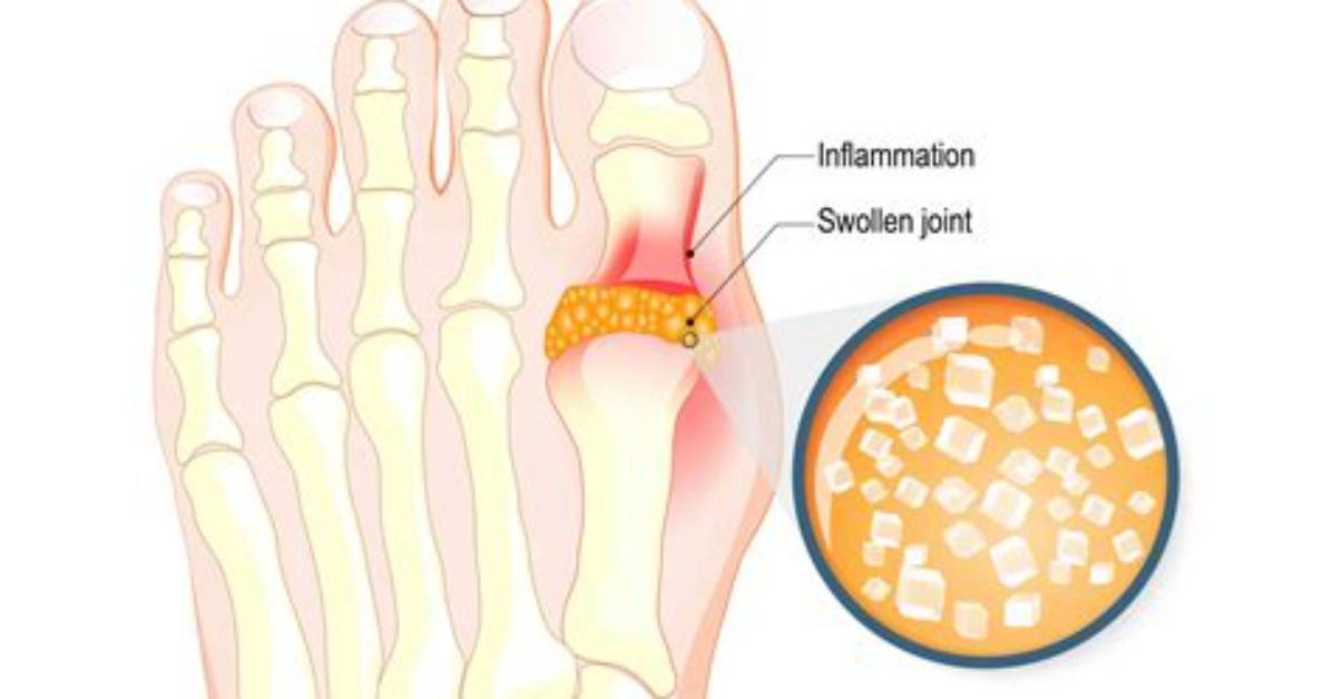 Why Does Gout Occur?