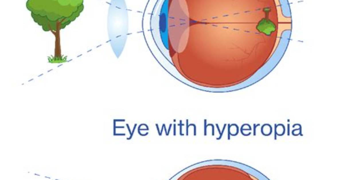 Why Does Hyperopia Occur?
