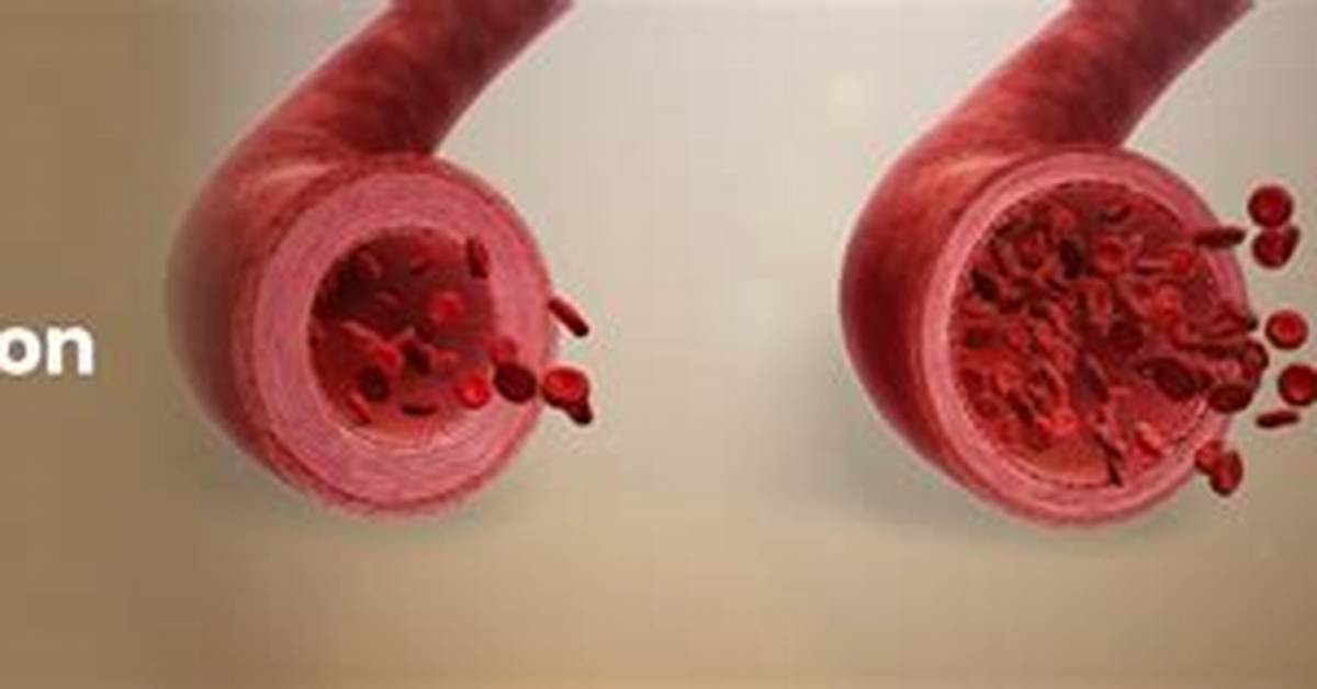 Why Does Hypertension Cause Vasoconstriction?