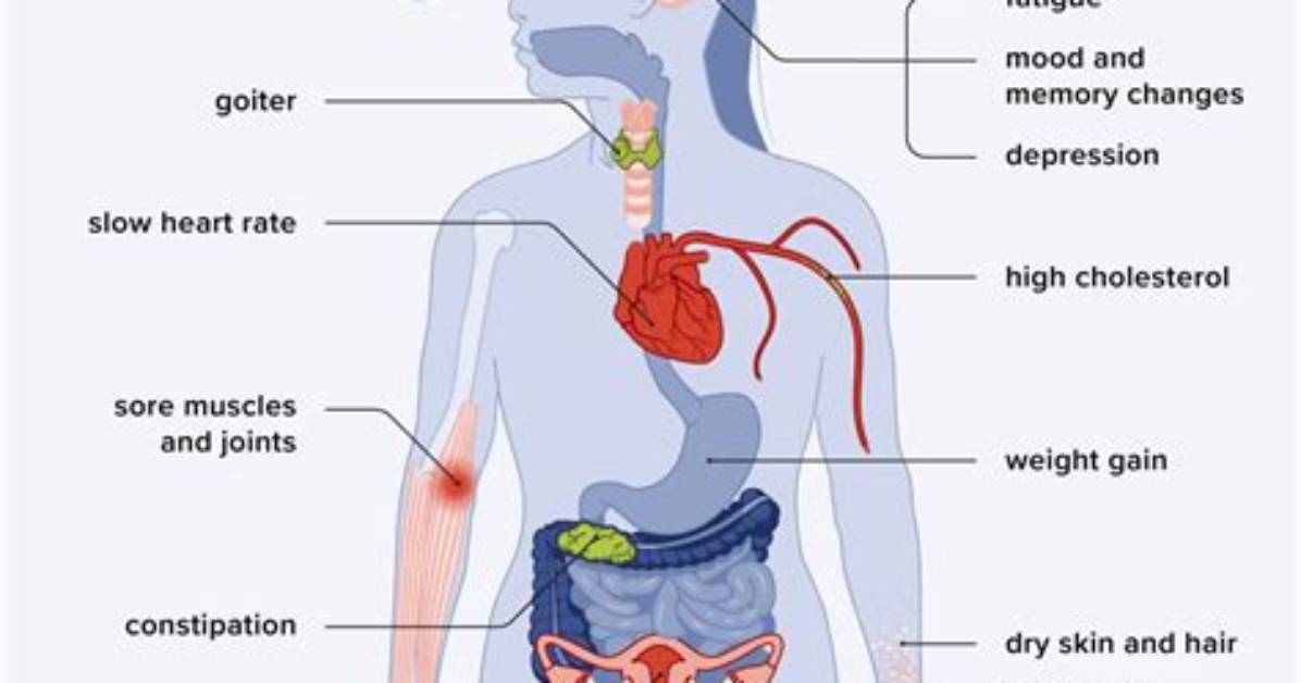 Why Does Hypothyroidism Cause Macroglossia?