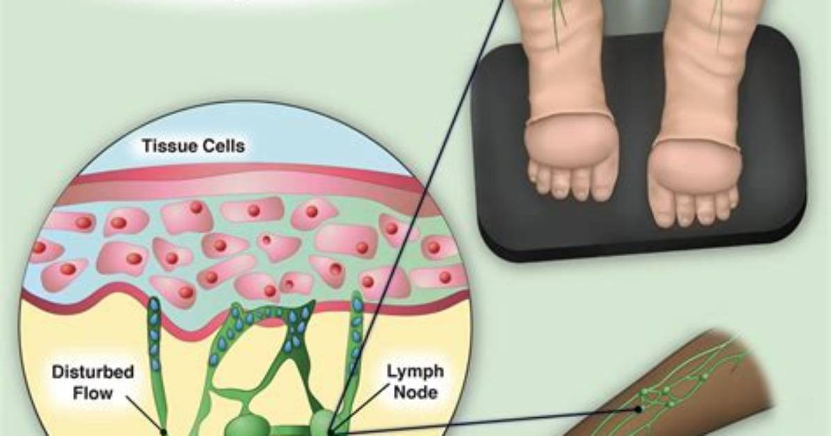 Why Does Lymphedema Occur?