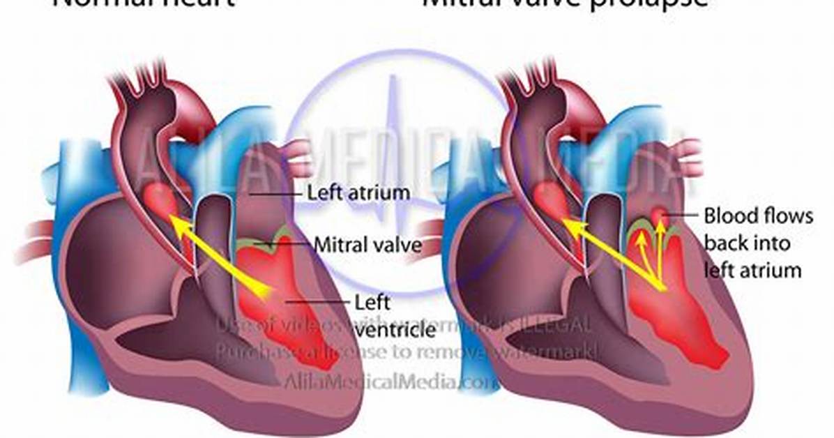 Why Does Mitral Valve Prolapse Murmur Increases with Valsalva