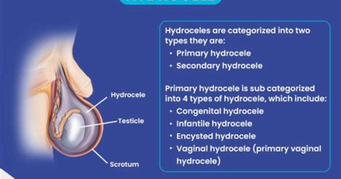 Why Does My Hydrocele Hurt