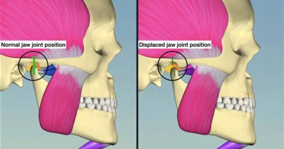 Why Does My Mandibular Nerve Hurt?