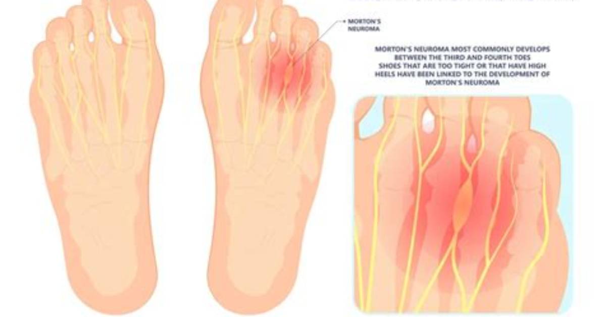 Why Does Neuroma Occur?