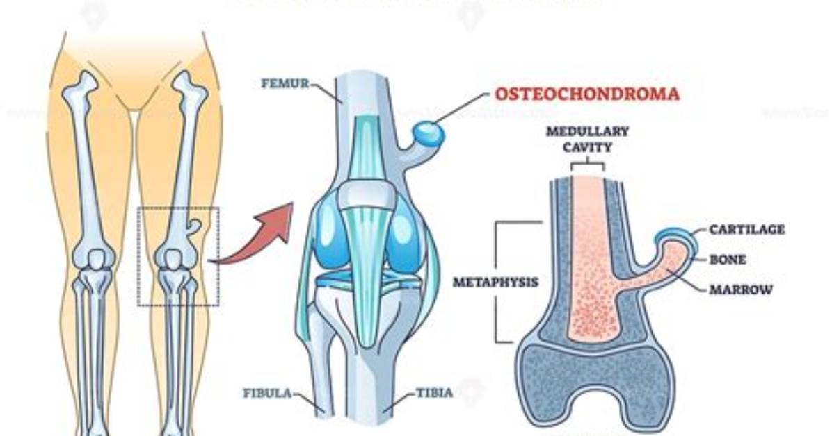 Why Does Osteochondroma Happen?