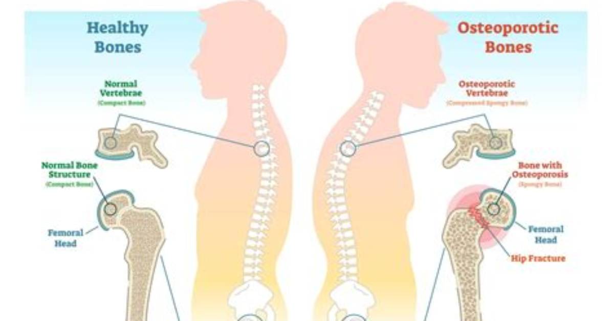 Why Does Osteopetrosis Occur?