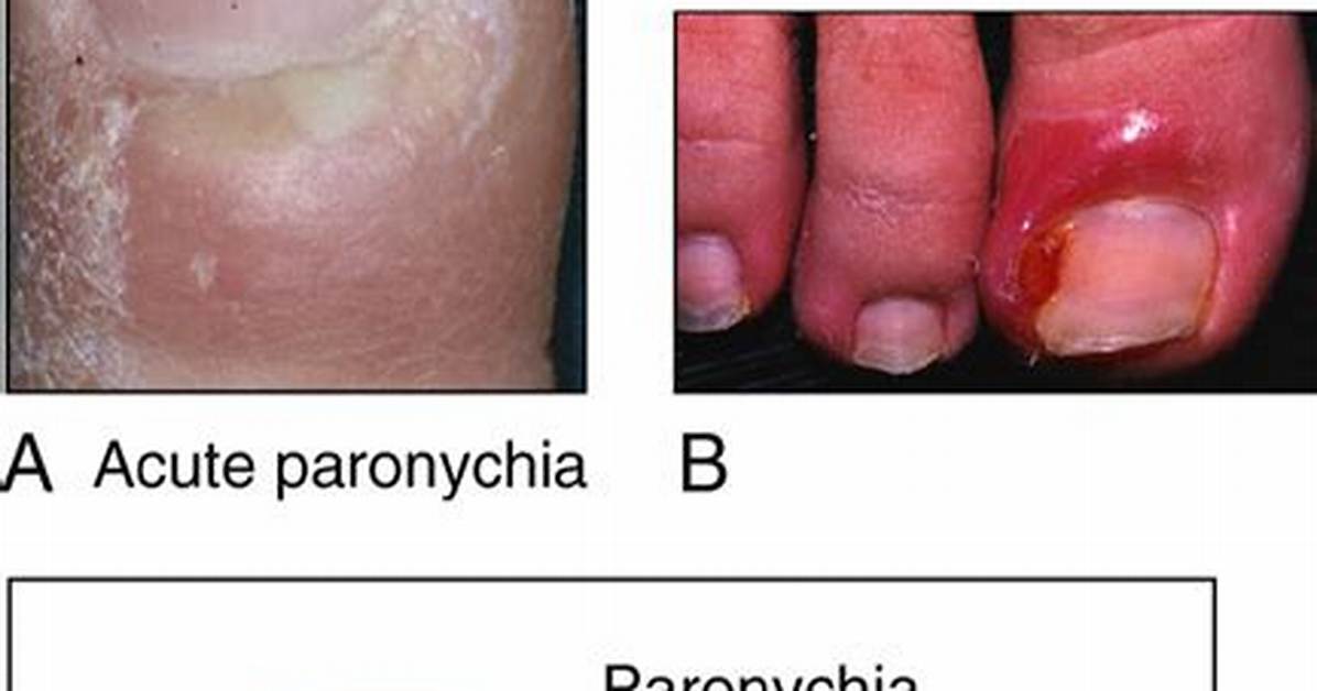 Why Does Paronychia Occur?