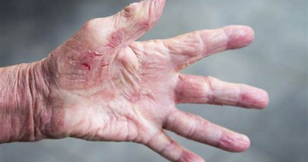 Why Does Skin Prune