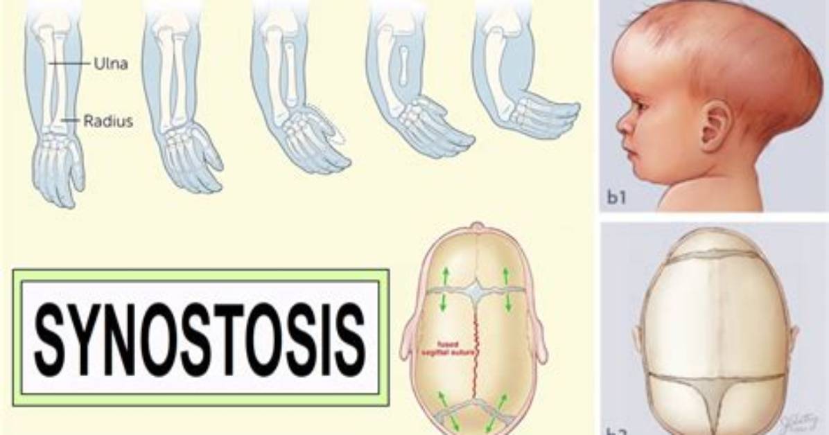 Why Does Synostosis Happen?