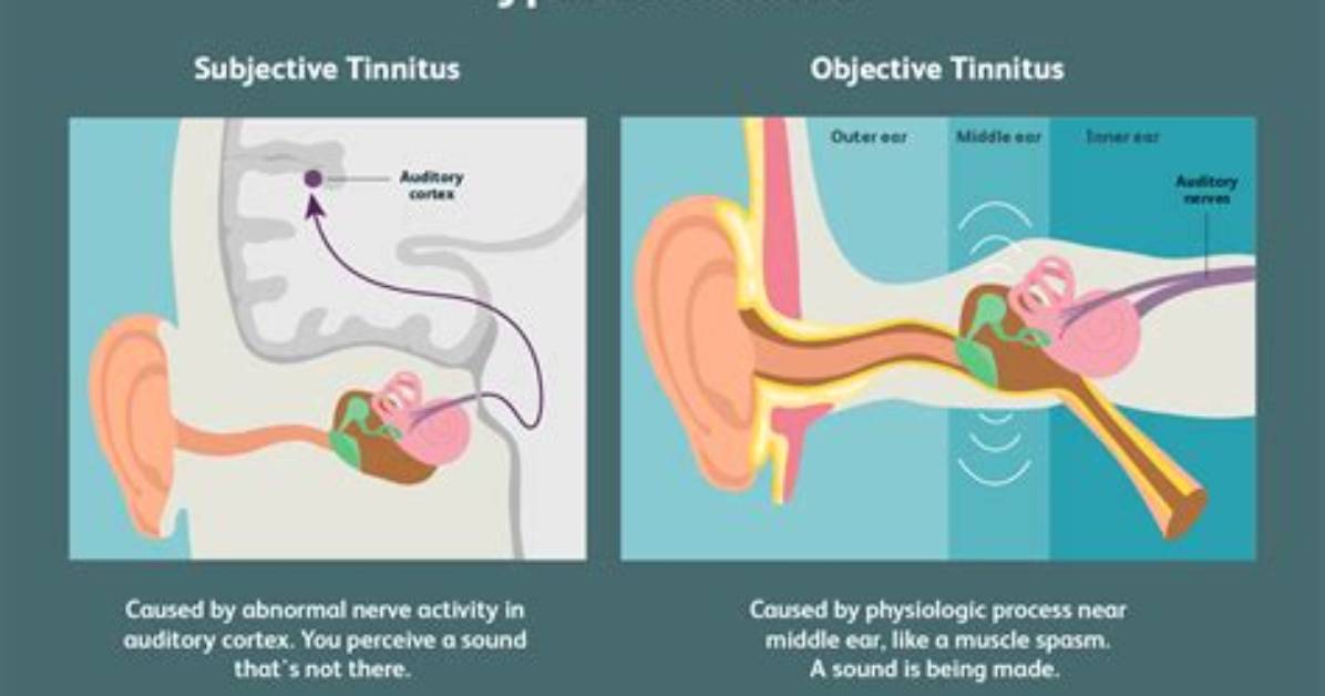 Why Does Tinnitus Suddenly Stop?