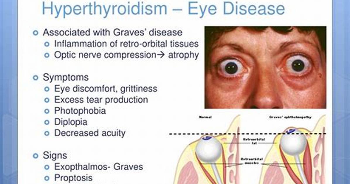 Why Hyperthyroidism Cause Exophthalmos?